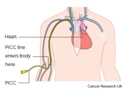 picc-line